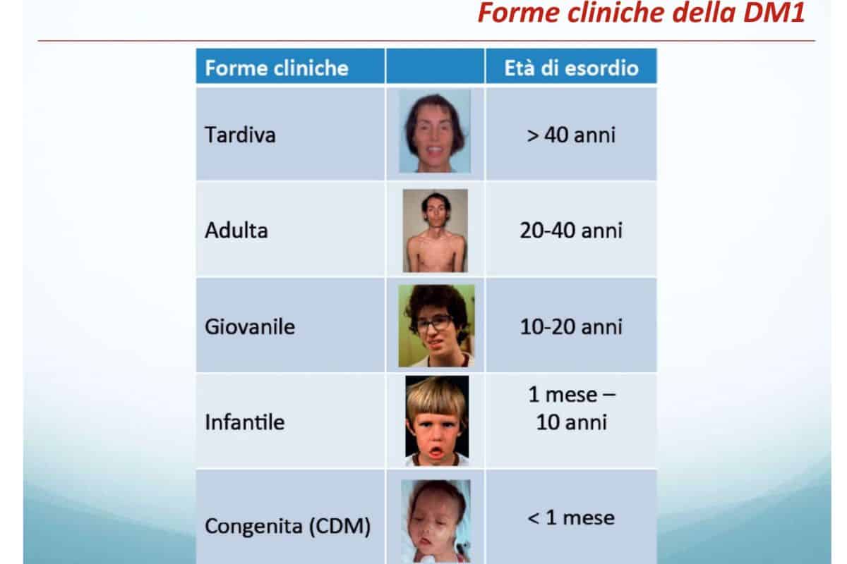 Distrofie miotoniche-forme-cliniche-FMM